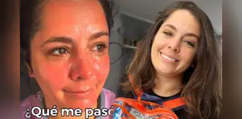 ¡Delicado! Yiddá Eslava sufre quemadura y preocupa a sus seguidores: ¿qué le pasó?