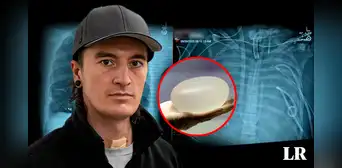Hombre que fumaba mucho recibe implantes mamarios para salvar su vida de enfermedad terminal