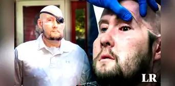 Médicos de EE. UU. logran realizar el primer trasplante de ojo en el mundo