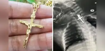 Bebé tenía un crucifijo alojado en su esófago: médicos de La Libertad la operaron con éxito Bebé tenía un crucifijo alojado en su esófago: médicos de La Libertad la operaron con éxito