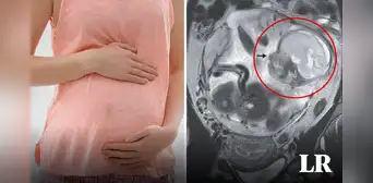 Fue al hospital por dolor de estómago y descubre que está embarazada: feto crecía en el intestino