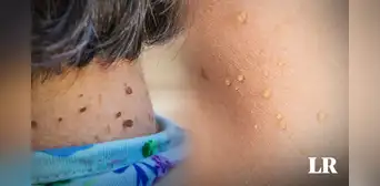 ¿Por qué me salen lunares de carne en el cuello o axilas y cómo eliminarlos? Especialistas lo explican