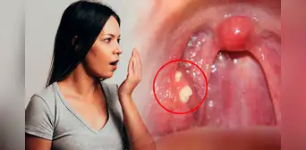 ¿Por qué me salen bolitas amarillas en la garganta y cómo puedo eliminarlas para no tener mal aliento? ¿Por qué me salen bolitas amarillas en la garganta y cómo puedo eliminarlas para no tener mal aliento?