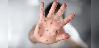 Minsa identifica caso importado de sarampión tras declarar alerta epidemiológica en el Perú