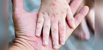 El sarampión reaparece por los antivacunas El sarampión reaparece por los antivacunas