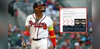 ¿Ronald Acuña Jr. superará su lesión?: este fue el llamativo análisis de médico especialista ¿Ronald Acuña Jr. superará su lesión?: este fue el llamativo análisis de médico especialista