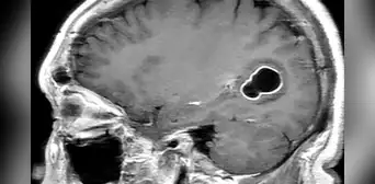 Médicos en EE. UU. encuentran larvas en el cerebro de hombre con migrañas Médicos en EE. UU. encuentran larvas en el cerebro de hombre con migrañas