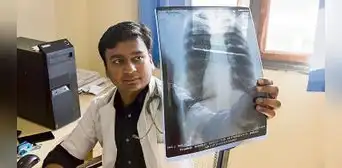 Cada año se reportan 30 mil casos de tuberculosis en el Perú Cada año se reportan 30 mil casos de tuberculosis en el Perú