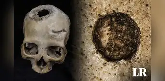 Así fue la primera operación contra el cáncer de la historia descubierta en un cráneo de Egipto Así fue la primera operación contra el cáncer de la historia descubierta en un cráneo de Egipto