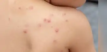 Síntomas de mpox y cómo se contagia: la enfermedad que ha causado más de 400 muertes en África este año