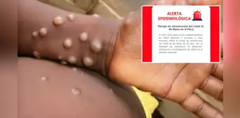 Minsa emite alerta epidemiológica a establecimientos de salud por nueva variante de la viruela del mono Minsa emite alerta epidemiológica a establecimientos de salud por nueva variante de la viruela del mono