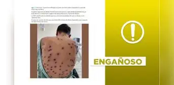 Foto no muestra "primer caso de viruela del mono fuera de África" reportado por Suecia en 2024 Foto no muestra "primer caso de viruela del mono fuera de África" reportado por Suecia en 2024