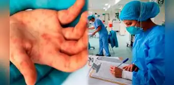 Perú: hay 77 casos de viruela del mono de la cepa clásica