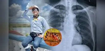 ¿Qué es el derrame pleural?: La complicación por dengue que acabó con la vida del 'Ingeniero Bailarín' a sus 34 años ¿Qué es el derrame pleural?: La complicación por dengue que acabó con la vida del 'Ingeniero Bailarín' a sus 34 años