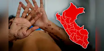 Viruela del mono continúa en aumento diario en el Perú: cifras, regiones más afectadas y todo lo que se sabe Viruela del mono continúa en aumento diario en el Perú: cifras, regiones más afectadas y todo lo que se sabe