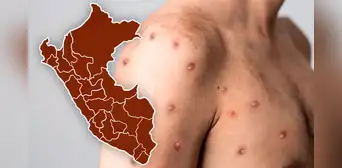 Viruela del mono en Perú: cómo se contagia, cuáles son los síntomas y precauciones para evitar contagio Viruela del mono en Perú: cómo se contagia, cuáles son los síntomas y precauciones para evitar contagio