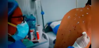Minsa reporta primer caso de viruela del mono en Huancayo: Hospital Carrión activa triaje especialista Minsa reporta primer caso de viruela del mono en Huancayo: Hospital Carrión activa triaje especialista