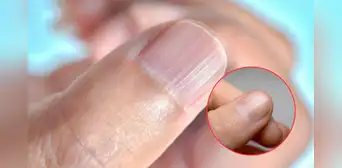 ¿Qué significa tener las uñas con rayas? Esto podría decir de tu salud y así puedes eliminarlas ¿Qué significa tener las uñas con rayas? Esto podría decir de tu salud y así puedes eliminarlas