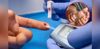 Diabetes en Perú: 1 de cada 5 pacientes es hospitalizado por pie diabético y el 17% tiene riesgo de amputación Diabetes en Perú: 1 de cada 5 pacientes es hospitalizado por pie diabético y el 17% tiene riesgo de amputación