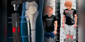 Así es la cirugía extrema para ser más alto: "Te rompen los huesos de las piernas para crecer hasta 15 centímetros" Así es la cirugía extrema para ser más alto: "Te rompen los huesos de las piernas para crecer hasta 15 centímetros"