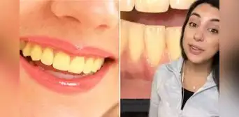 Dentista revela la verdadera razón detrás de los dientes amarillos, ¡aunque te cepilles diario! Dentista revela la verdadera razón detrás de los dientes amarillos, ¡aunque te cepilles diario!
