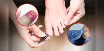 Las peligrosas enfermedades que puedes contraer por compartir el cortaúñas con otras personas: herpes entre las infecciones Las peligrosas enfermedades que puedes contraer por compartir el cortaúñas con otras personas: herpes entre las infecciones