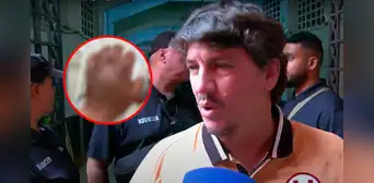 Jean Ferrari muestra fuerte imagen de cómo quedó la mano de Rodrigo Ureña tras el Universitario vs Boys: "Esto no se debe permitir"