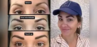 Mujer revela cómo un trasplante de cejas de más de US$5.000 le cambió la vida tras años de depilación excesiva: "Lo volvería a hacer"