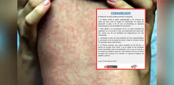 Minsa emite alerta epidemiológica por caso importado de sarampión desde Estados Unidos Minsa emite alerta epidemiológica por caso importado de sarampión desde Estados Unidos