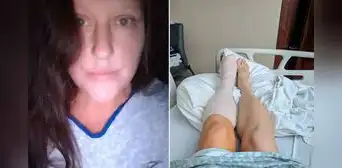 Mujer estuvo al borde de la muerte por una uña encarnada: terminó con medio pie amputado tras una sepsis letal Mujer estuvo al borde de la muerte por una uña encarnada: terminó con medio pie amputado tras una sepsis letal