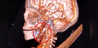 Niño de 7 años sobrevive a un terrible accidente en la India: un clavo de 3 pulgadas se incrustó en su cerebro Niño de 7 años sobrevive a un terrible accidente en la India: un clavo de 3 pulgadas se incrustó en su cerebro