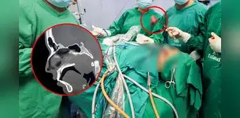 Sin abrir el cráneo, médicos de La Libertad extraen tumor nasal gigante a adolescente de 17 años Sin abrir el cráneo, médicos de La Libertad extraen tumor nasal gigante a adolescente de 17 años
