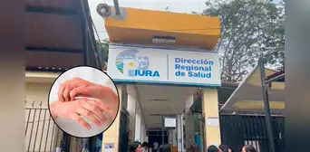 Lepra en Piura: Dirección Regional de Salud reporta el primer caso del 2025