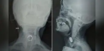 Mujer de 85 años comió un anillo mientras dormía: soñó que era caramelo y terminó internada en hospital de Lima