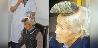 El insólito caso de la "abuela unicornio", la mujer china a la que le creció un cuerno de trece centímetros en la frente
