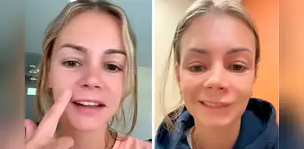 Mujer de EEUU se revienta un grano en el rostro, se infecta de bacterias y por poco pierde la vida