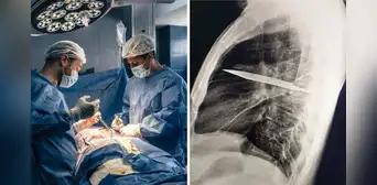 El increíble caso del hombre que vivió 8 años con un cuchillo en el pecho sin saberlo: médicos lo descubrieron tras una infección El increíble caso del hombre que vivió 8 años con un cuchillo en el pecho sin saberlo: médicos lo descubrieron tras una infección