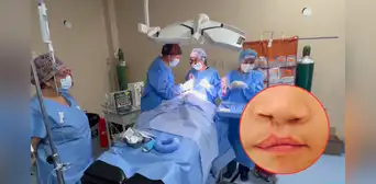 Arequipa: 40 niños serán operados gratis por labio fisurado y paladar hendido en campaña solidaria Arequipa: 40 niños serán operados gratis por labio fisurado y paladar hendido en campaña solidaria
