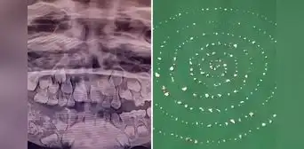 El insólito caso del menor que tenía 526 dientes en la mandíbula y se los extrajeron en una sola cirugía en la India