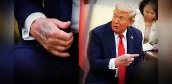 Trump aparece con moretones en las manos y genera preocupación por su estado de salud: ¿qué dicen los médicos? Trump aparece con moretones en las manos y genera preocupación por su estado de salud: ¿qué dicen los médicos?