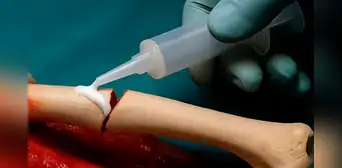 Científicos chinos crean un pegamento para huesos que repara fracturas en solo tres minutos de forma rápida y segura