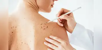 Avance contra el cáncer de piel: investigadores argentinos crean una vacuna para tratar el melanoma y ya está disponible Avance contra el cáncer de piel: investigadores argentinos crean una vacuna para tratar el melanoma y ya está disponible