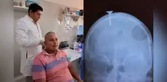 Obrero sobrevive a lesión en la cabeza ocasionada por clavo en Loreto: pistola neumática se activó por accidente