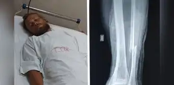 Turista ruso que recorría el mundo en bicicleta fue atropellado en Áncash y sufre grave lesión