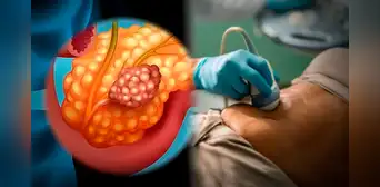 Científicos españoles avanzan en una terapia esperanzadora para eliminar completamente el cáncer de páncreas Científicos españoles avanzan en una terapia esperanzadora para eliminar completamente el cáncer de páncreas
