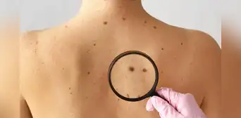 Las recomendaciones del Minsa para la detección temprana de lunares sospechosos y descartar cáncer de piel Las recomendaciones del Minsa para la detección temprana de lunares sospechosos y descartar cáncer de piel