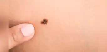 El melanoma en Perú: cómo reconocer a tiempo el cáncer de piel más agresivo El melanoma en Perú: cómo reconocer a tiempo el cáncer de piel más agresivo