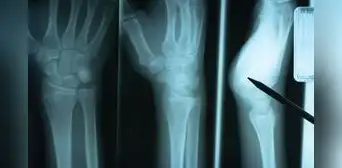 Estudio científico descubre proteína clave para la reparación de huesos después de sufrir una fractura Estudio científico descubre proteína clave para la reparación de huesos después de sufrir una fractura