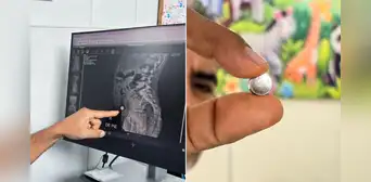 Niña de 6 años sobrevive a perforación intestinal tras ingerir pila de reloj: necesitó cirugía de más de tres horas