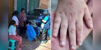 Brote de sarampión: casos se cuadruplican en solo tres días durante alerta sanitaria en Puno